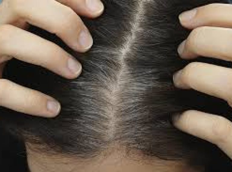 Warum fallen die Haare aus? Ursachen und Methoden gegen Haarausfall