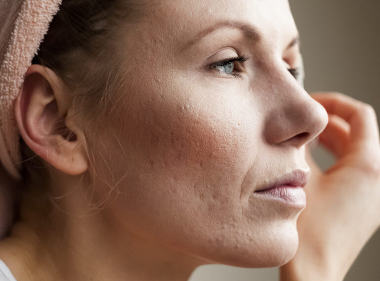 Ursachen für Akne bei Erwachsenen – Behandlung, Kosmetikprodukte und Hausmittel